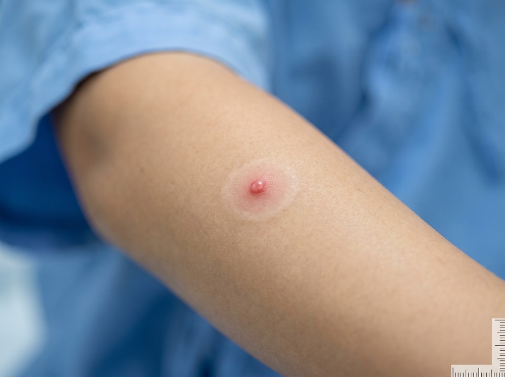 Extreme close-up of skin showing a barely visible tiny pink pinprick mark with no surrounding swelling or redness